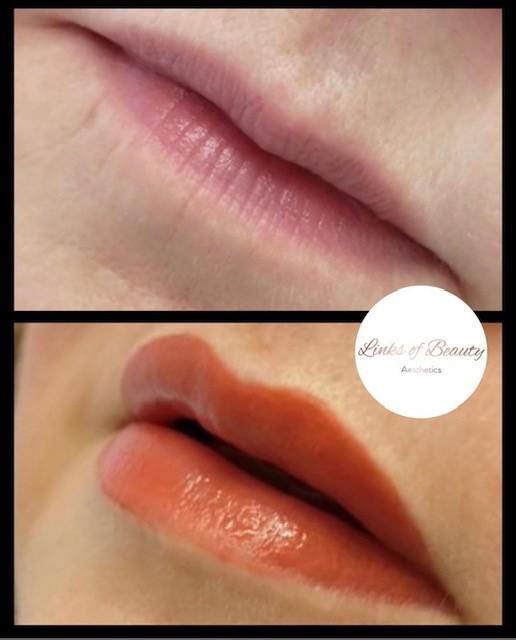 Lip treatment before and after comparison