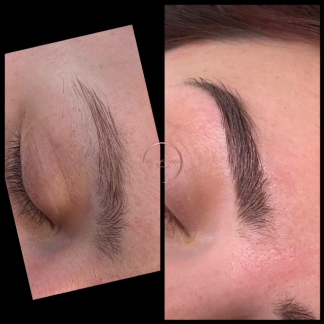 Brow treatment result comparison