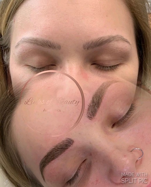 Brow treatment photographs