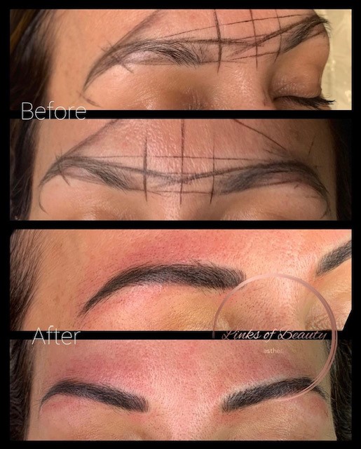 Brow mapping and treatment results